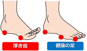 浮き指歩き 知っていますか 筑紫野市のくまがい整骨院 整体院 福岡県で口コミ高評価